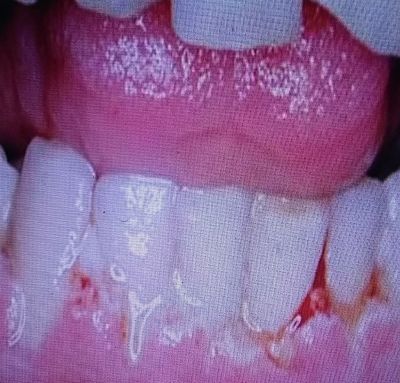 Paciente que presenta una gingivorragia bucal en la encía inferior