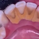 Sarro dental por dentro en los dientes inferiores