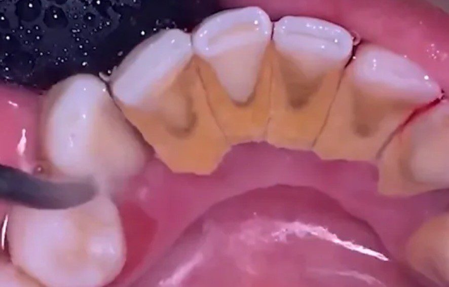Sarro dental por dentro en los dientes inferiores