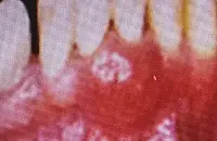 absceso periodontal