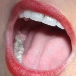 Mujer con pericoronaritis aguda del tercer molar inferior derecho