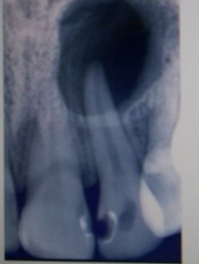 procesos periapicales crónicos, Procesos periapicales crónicos que se forman en los dientes 💥, odonton