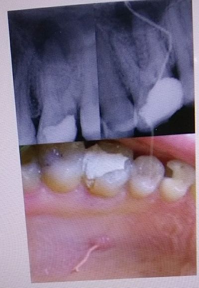 procesos periapicales crónicos, Procesos periapicales crónicos que se forman en los dientes 💥, odonton