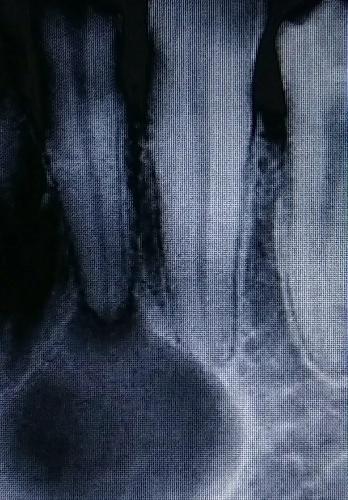 reabsorción radicular de un incisivo lateral causada por un quiste