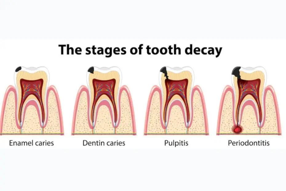 Caries dental definición, Definición de caries dental 🚀, odonton