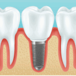 Implante dental de un molar
