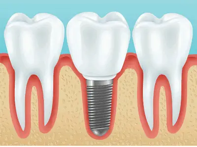 implante dental, ¿Que es un implante dental? 🚀, odonton