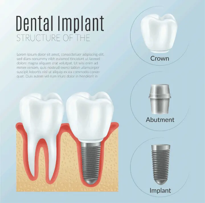Qué es un implante dental, ¿Por qué el implante dental es el mejor tipo de prótesis?🚀, odonton