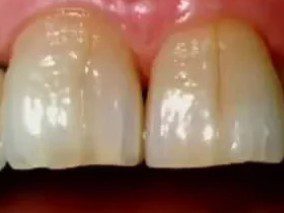 Infracción del esmalte. Líneas de fractura en los dientes