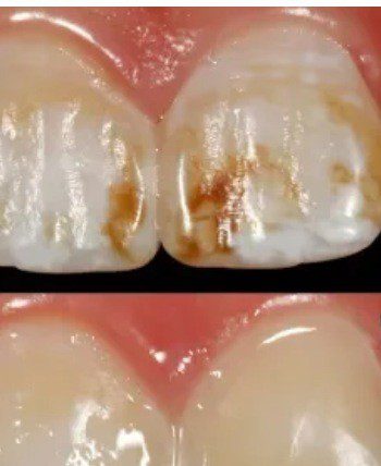 Fluorosis dental: ¿Qué es y como afecta los dientes?