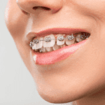 Joven con tratamiento de brackets en dientes superiores