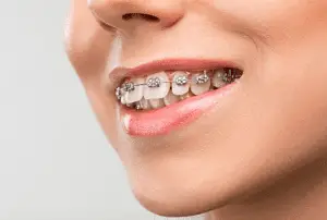 Qué es un Brackets, ¿Qué es un brackets de ortodoncia?, odonton