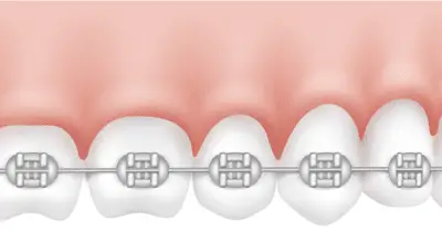 Brackets metálicos para ortodoncia: ventajas, desventajas y cómo funcionan.