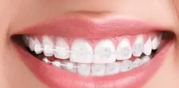 Brackets de zafiro: una opción estética y discreta para corregir tu dentadura.