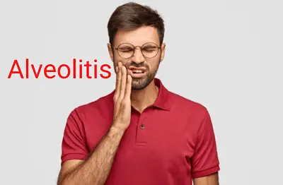Alveolitis dental, Alveolitis: Complicación más frecuente después de una extracción dental, odonton