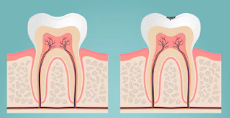 Ilustración de molares con dos conductos.En estos molares se realiza el tipo de endodoncia birradicular