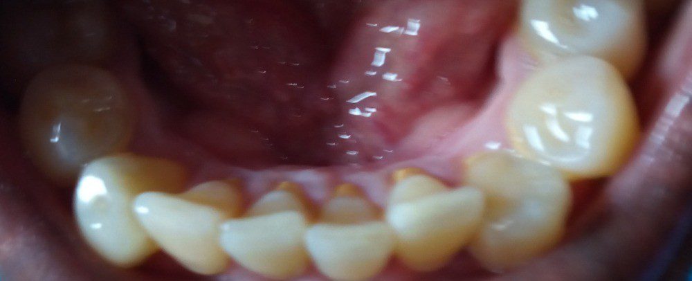 5 formas de como evitar el sarro en los dientes