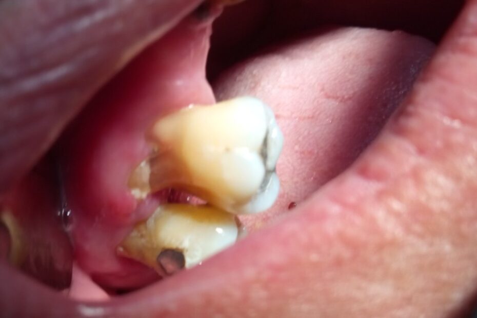 Molares superiores con raíces expuestas y pérdida de hueso a causa de periodontitis