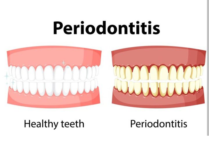 Periodontitis, Periodontitis, odonton