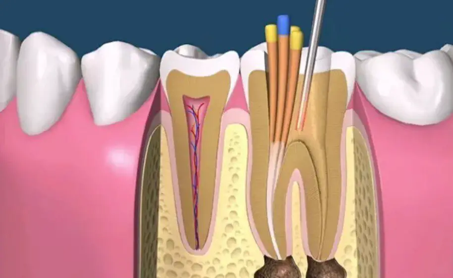 que es necropulpectomia, ¿Qué es necropulpectomia en endodoncia y cómo se realiza?, odonton