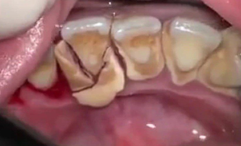Sarro dental en dientes inferiores