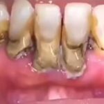 Tártaro dental en los dientes de abajo