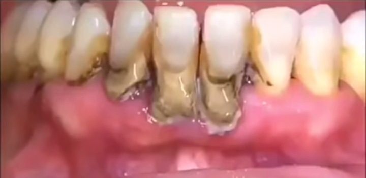 Tártaro dental en los dientes de abajo