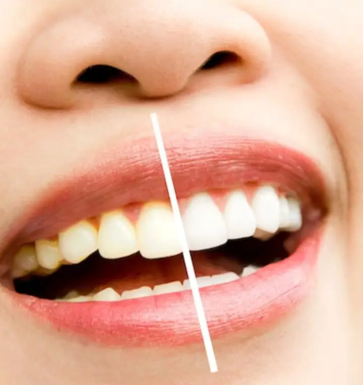 Blanqueamiento dental: Todo lo que necesitas saber