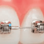 Brackets autoligables metálicos en dientes superiores