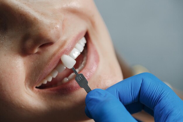 colocación de carilla dental en mujer joven