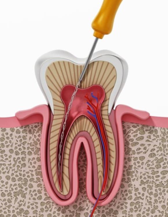 Un molar con una lima de endodoncia
