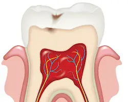 Representación de la pulpa dental en un vector de un molar